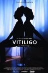 Vitiligo Movie Streaming Online